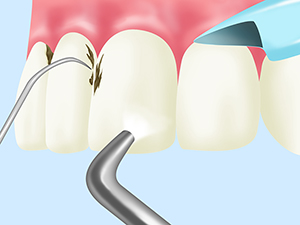 歯と歯の間の清掃